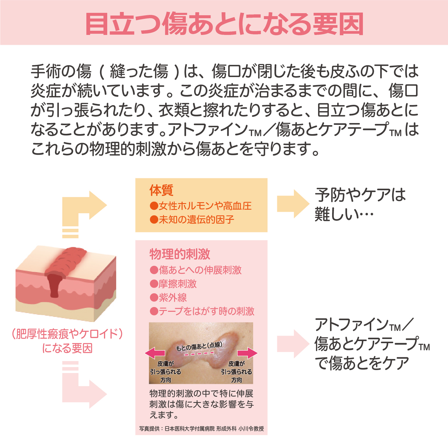 アトファイン LL 4枚